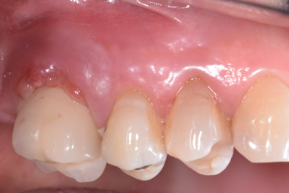 Periimplantitis before treatment